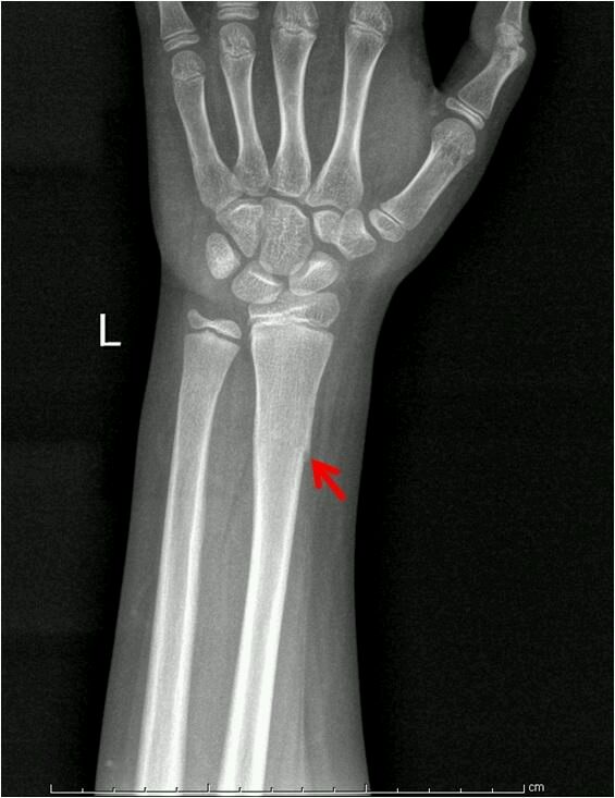 【健康】青枝骨折会自己恢复吗?