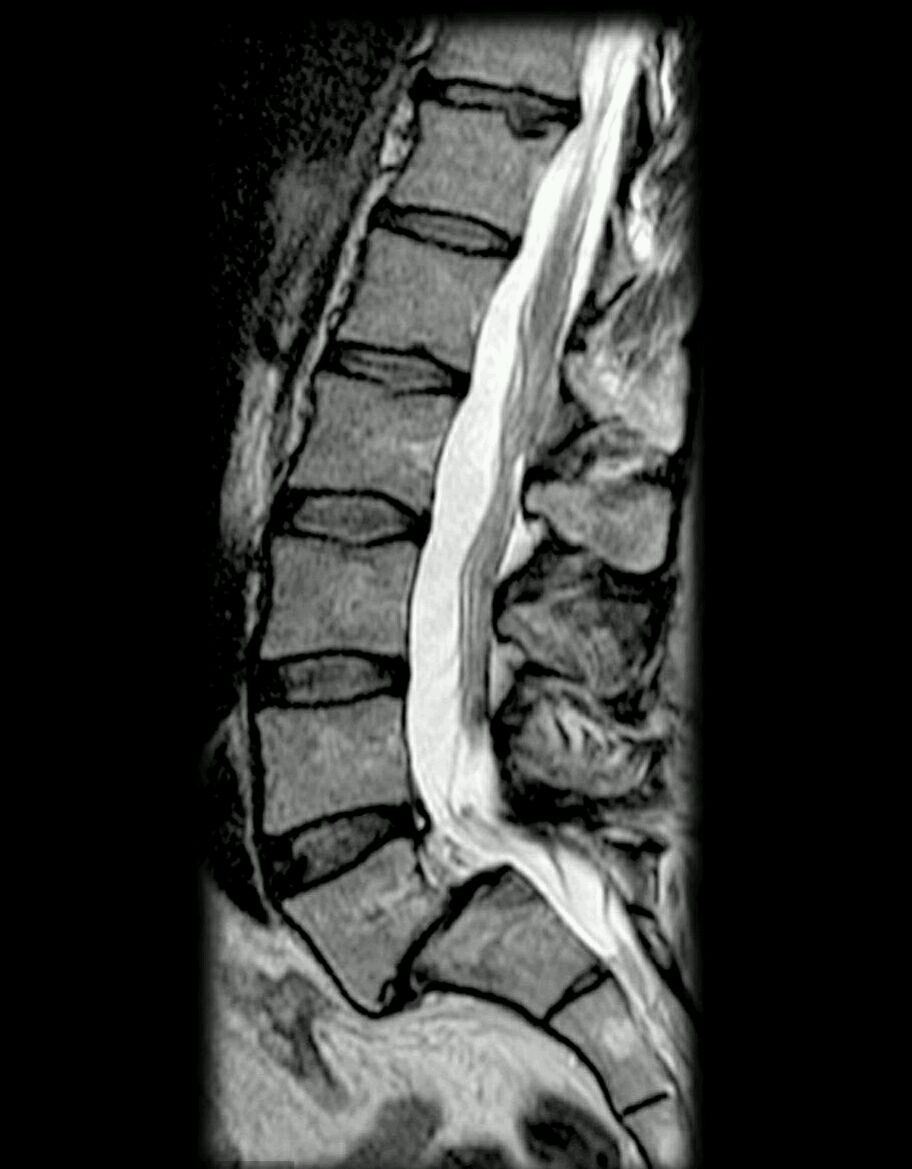 腰椎滑脱的保守治疗及手术治疗的适应症