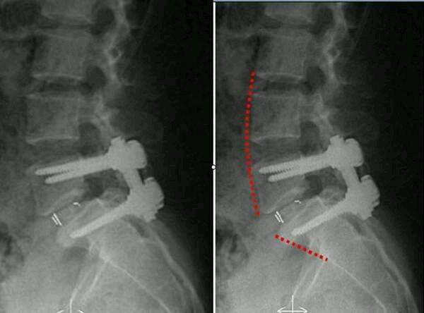 腰椎滑脱的保守治疗及手术治疗的适应症